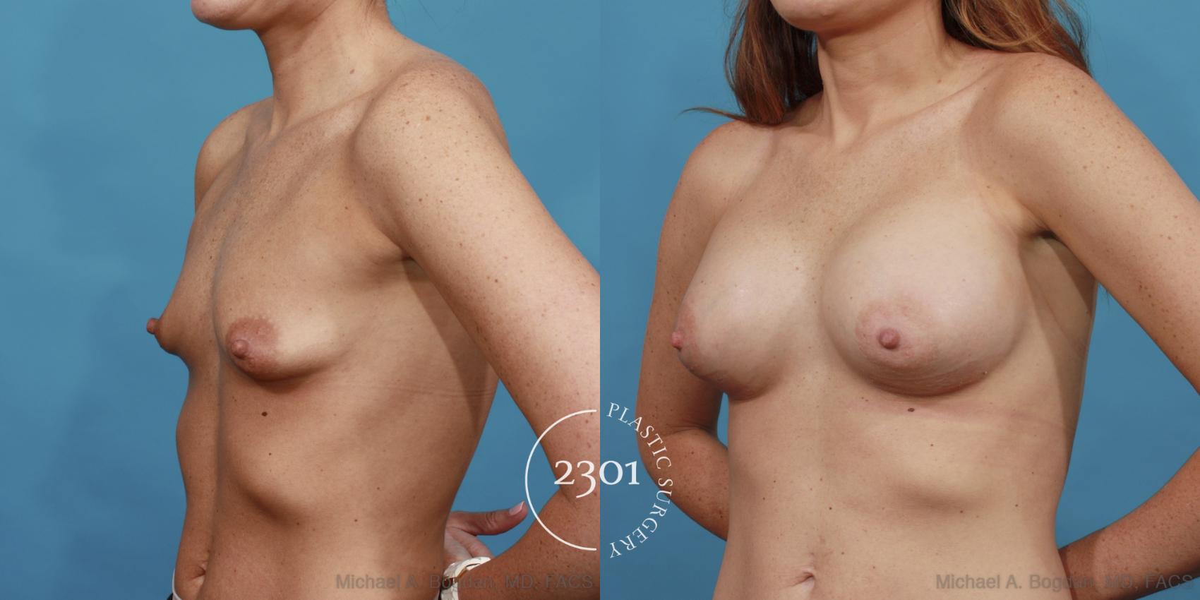 Before & After Silicone Implants Case 507 View #2 View in Fort Worth, Plano, & Frisco, Texas