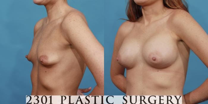 Before & After Silicone Implants Case 507 View #2 View in Fort Worth, Plano, & Frisco, Texas
