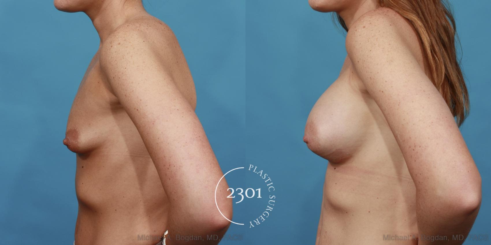 Before & After Silicone Implants Case 507 View #3 View in Fort Worth, Plano, & Frisco, Texas