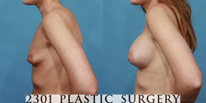 Before & After Silicone Implants Case 507 View #3 View in Fort Worth, Plano, & Frisco, Texas