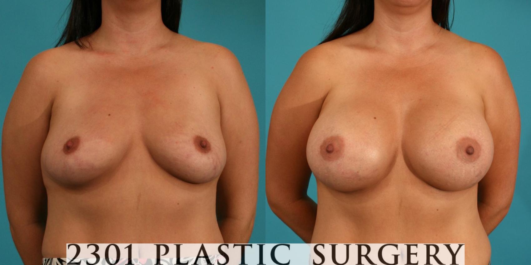Before & After Breast Augmentation Case 51 View #1 View in Fort Worth, Plano, & Frisco, Texas