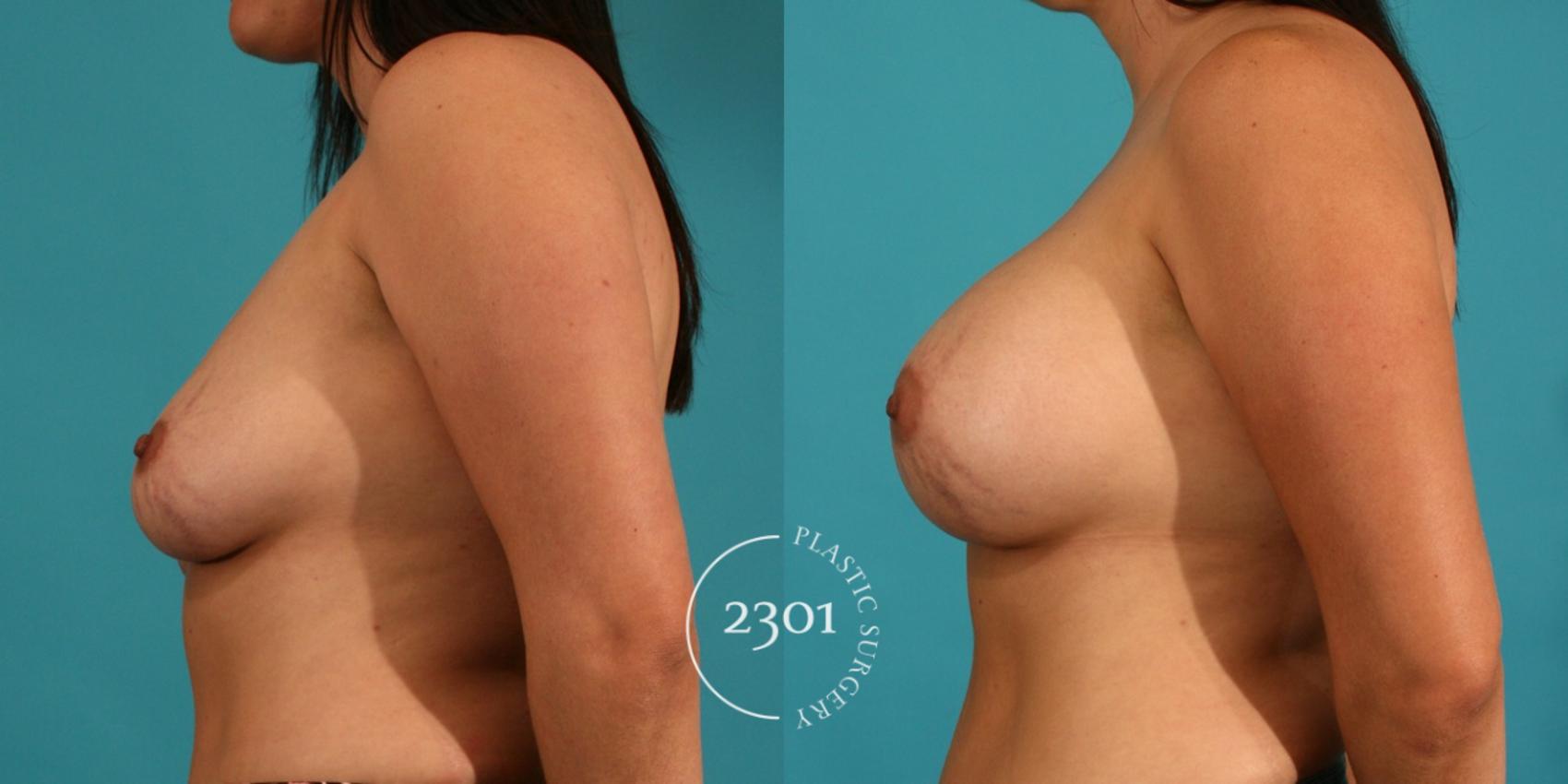 Before & After Silicone Implants Case 51 View #2 View in Fort Worth, Plano, & Frisco, Texas