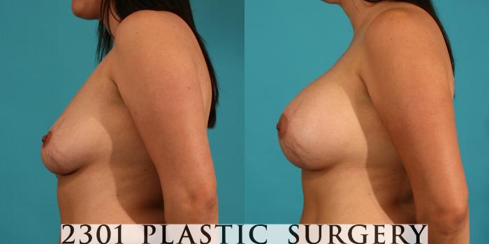 Before & After Silicone Implants Case 51 View #2 View in Fort Worth, Plano, & Frisco, Texas