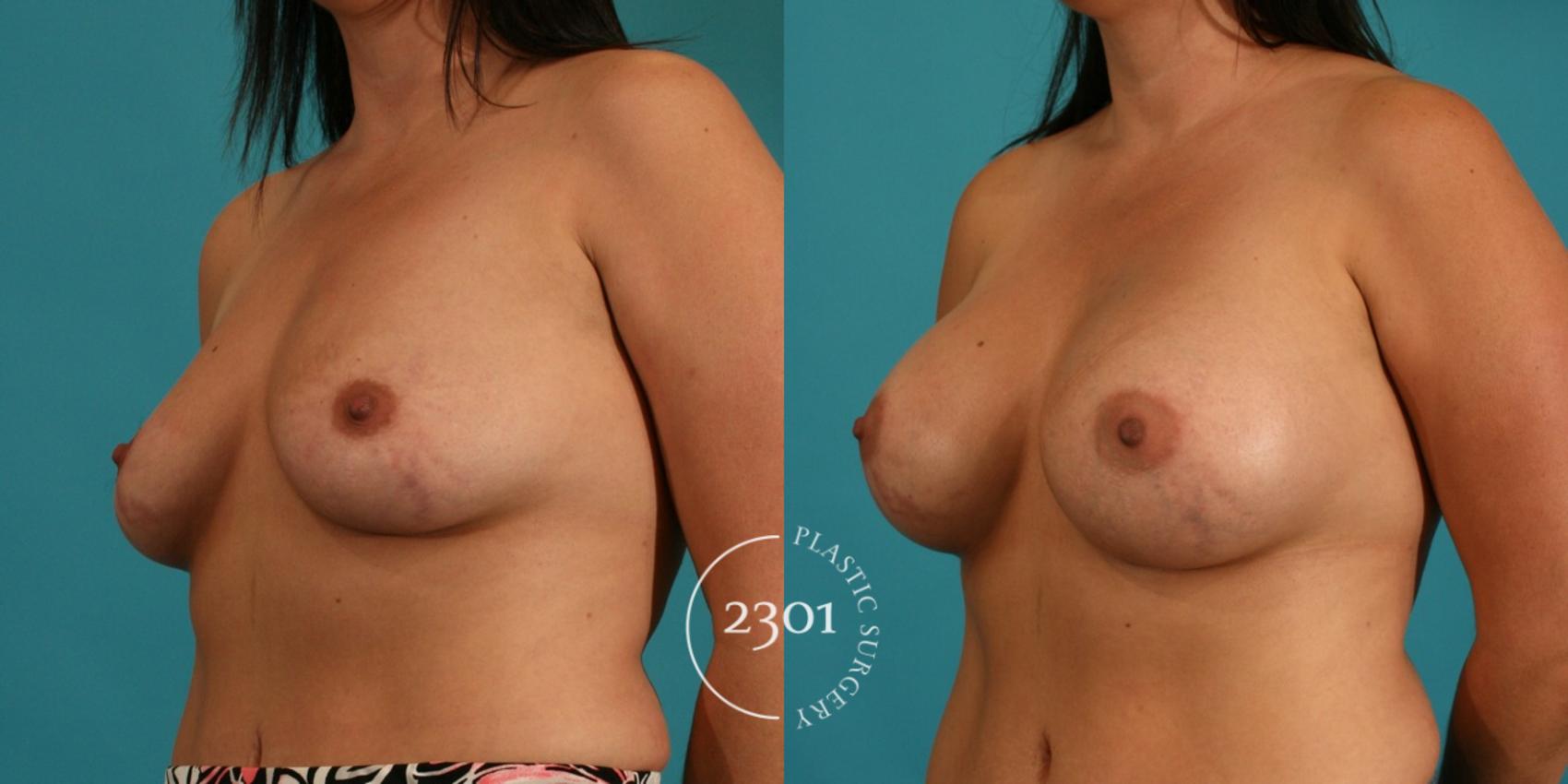Before & After Silicone Implants Case 51 View #3 View in Fort Worth, Plano, & Frisco, Texas
