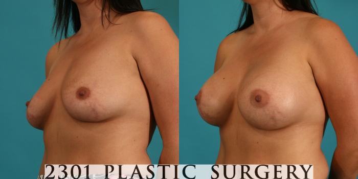 Before & After Breast Augmentation Case 51 View #3 View in Fort Worth, Plano, & Frisco, Texas