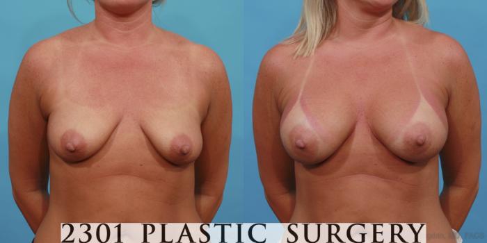 Before & After Silicone Implants Case 512 View #1 View in Fort Worth, Plano, & Frisco, Texas