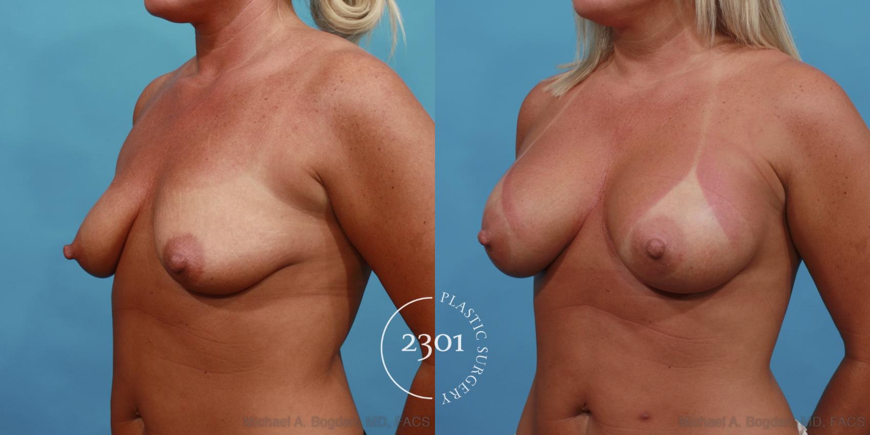 Before & After Silicone Implants Case 512 View #2 View in Fort Worth, Plano, & Frisco, Texas