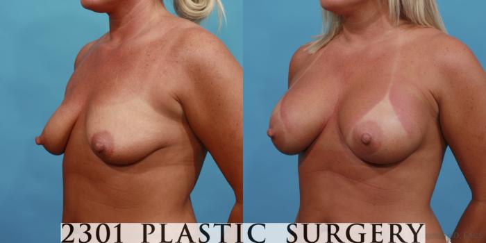 Before & After Silicone Implants Case 512 View #2 View in Fort Worth, Plano, & Frisco, Texas
