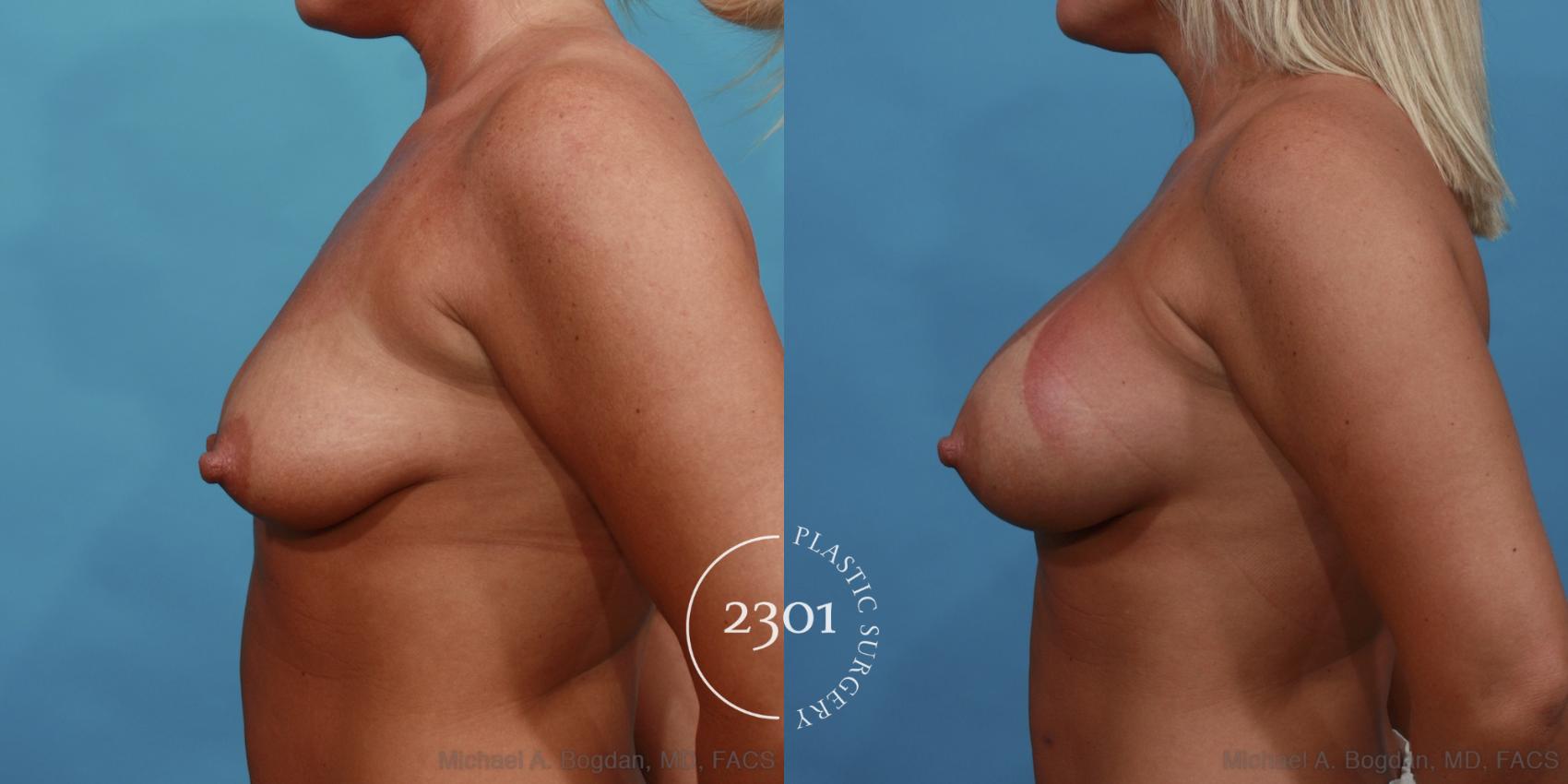 Before & After Silicone Implants Case 512 View #3 View in Fort Worth, Plano, & Frisco, Texas