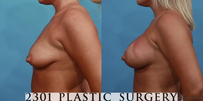 Before & After Silicone Implants Case 512 View #3 View in Fort Worth, Plano, & Frisco, Texas