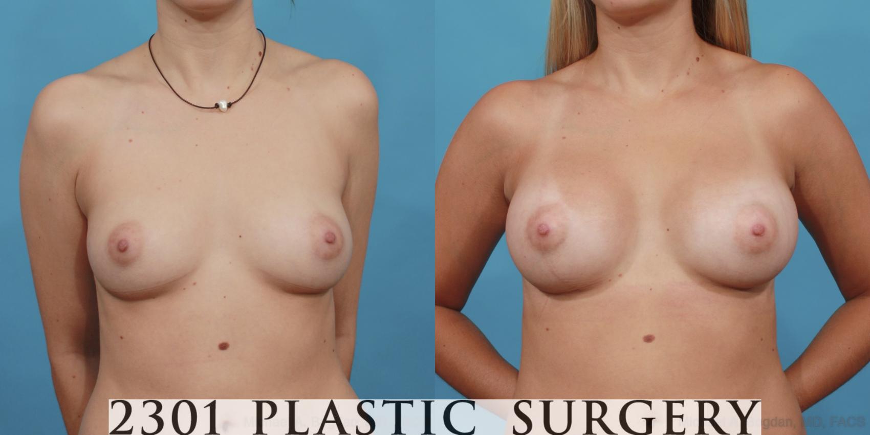 Before & After Silicone Implants Case 513 View #1 View in Fort Worth, Plano, & Frisco, Texas