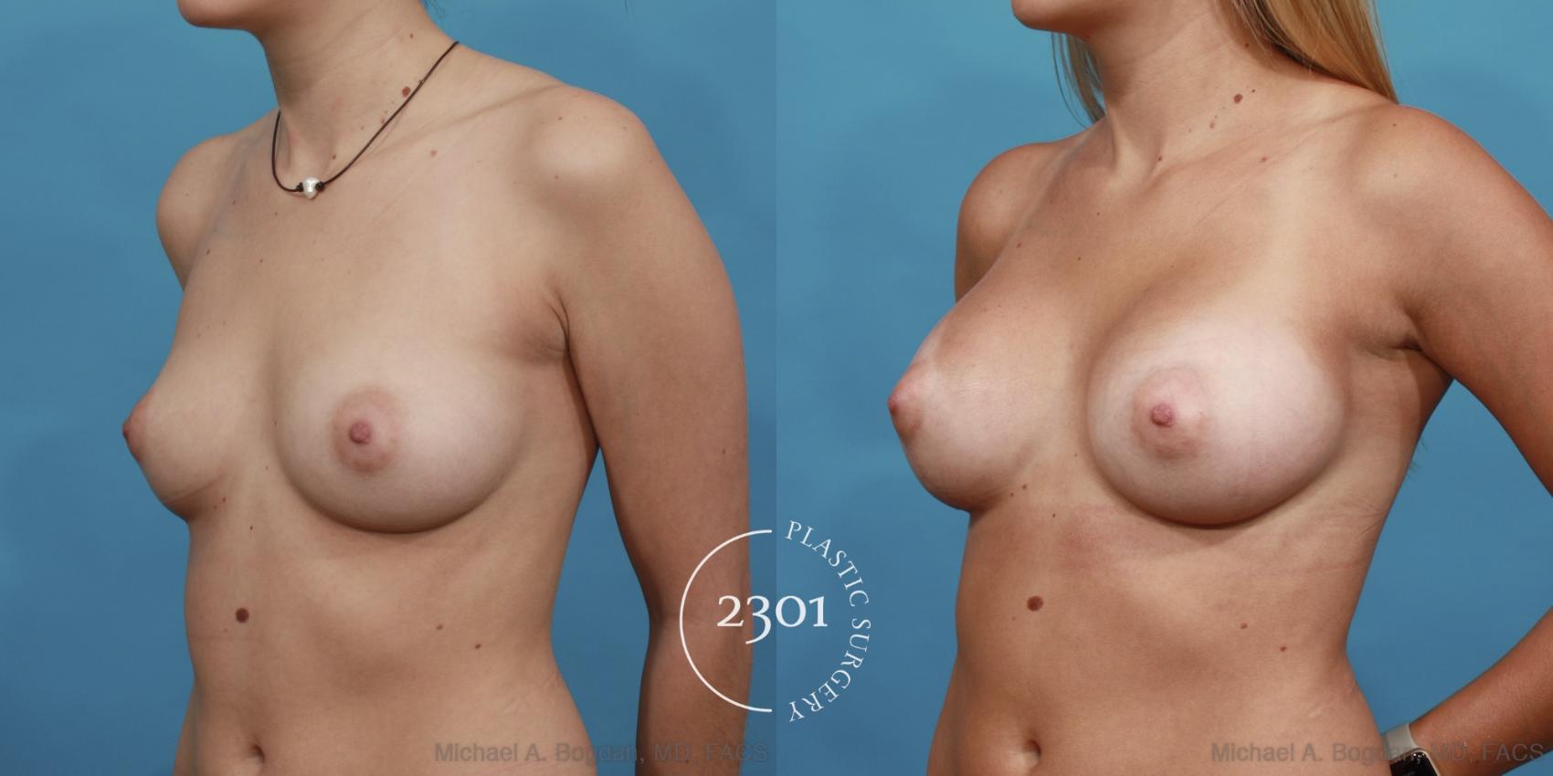 Before & After Silicone Implants Case 513 View #2 View in Fort Worth, Plano, & Frisco, Texas