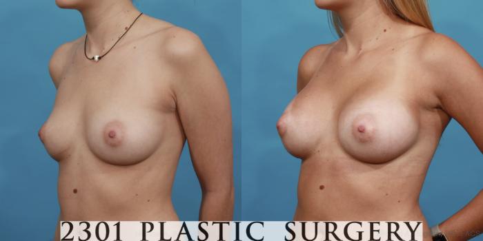 Before & After Silicone Implants Case 513 View #2 View in Fort Worth, Plano, & Frisco, Texas