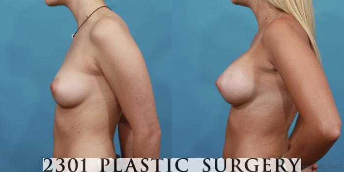 Before & After Silicone Implants Case 513 View #3 View in Fort Worth, Plano, & Frisco, Texas