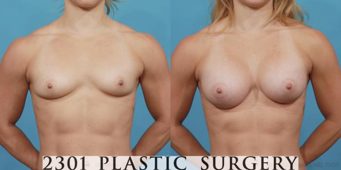 Before & After Silicone Implants Case 517 View #1 View in Fort Worth, Plano, & Frisco, Texas