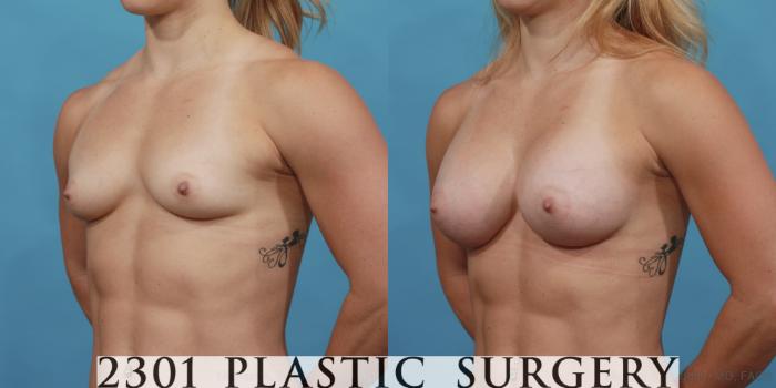 Before & After Silicone Implants Case 517 View #2 View in Fort Worth, Plano, & Frisco, Texas