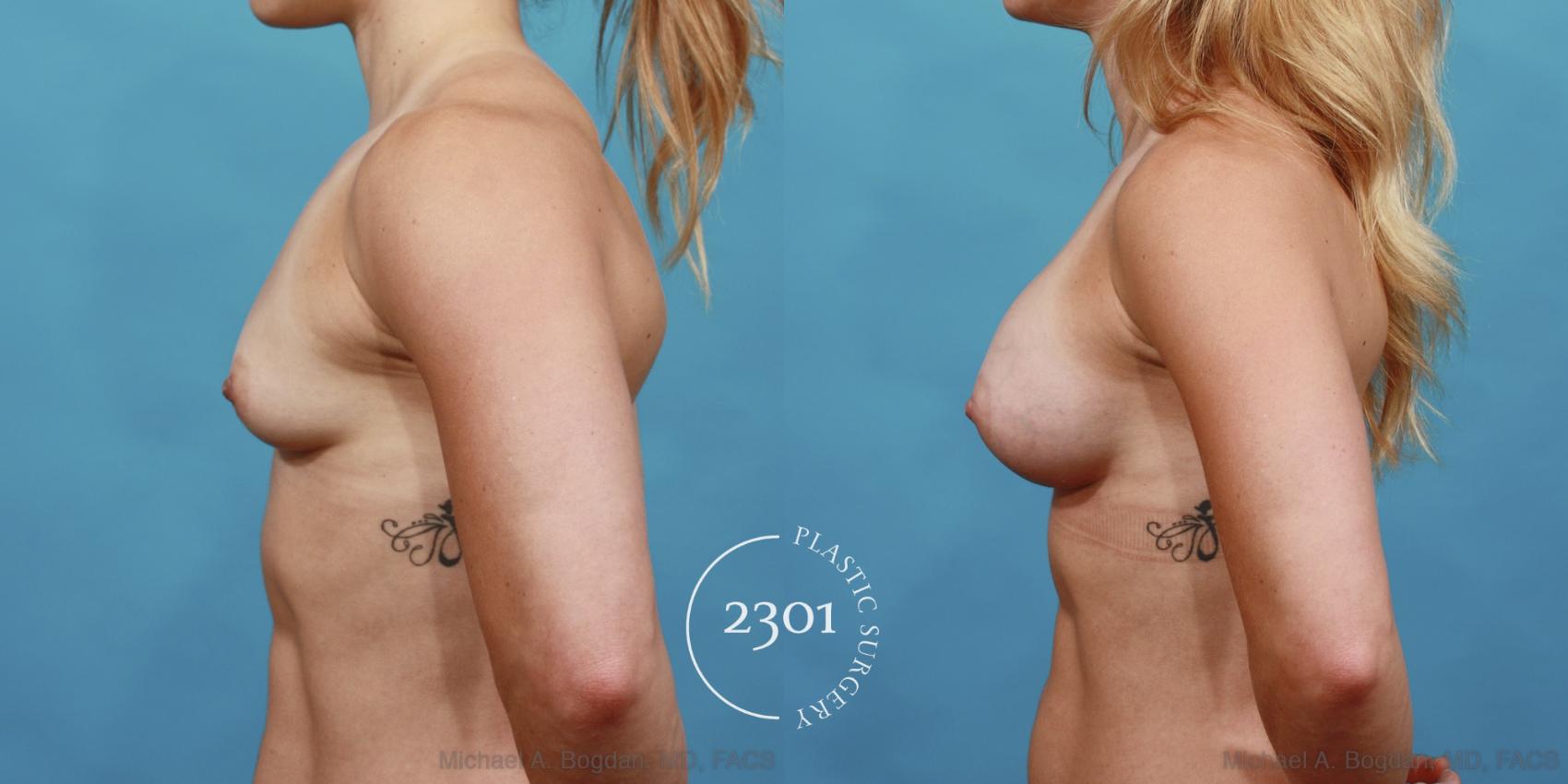 Before & After Silicone Implants Case 517 View #3 View in Fort Worth, Plano, & Frisco, Texas