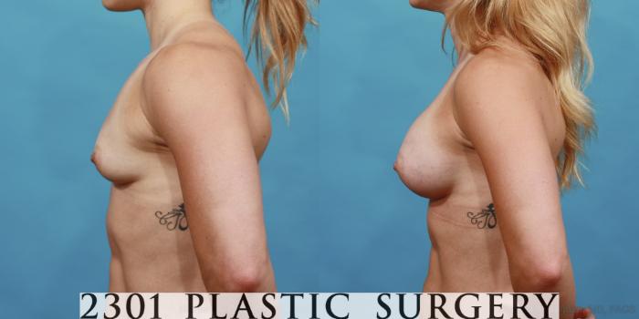 Before & After Silicone Implants Case 517 View #3 View in Fort Worth, Plano, & Frisco, Texas