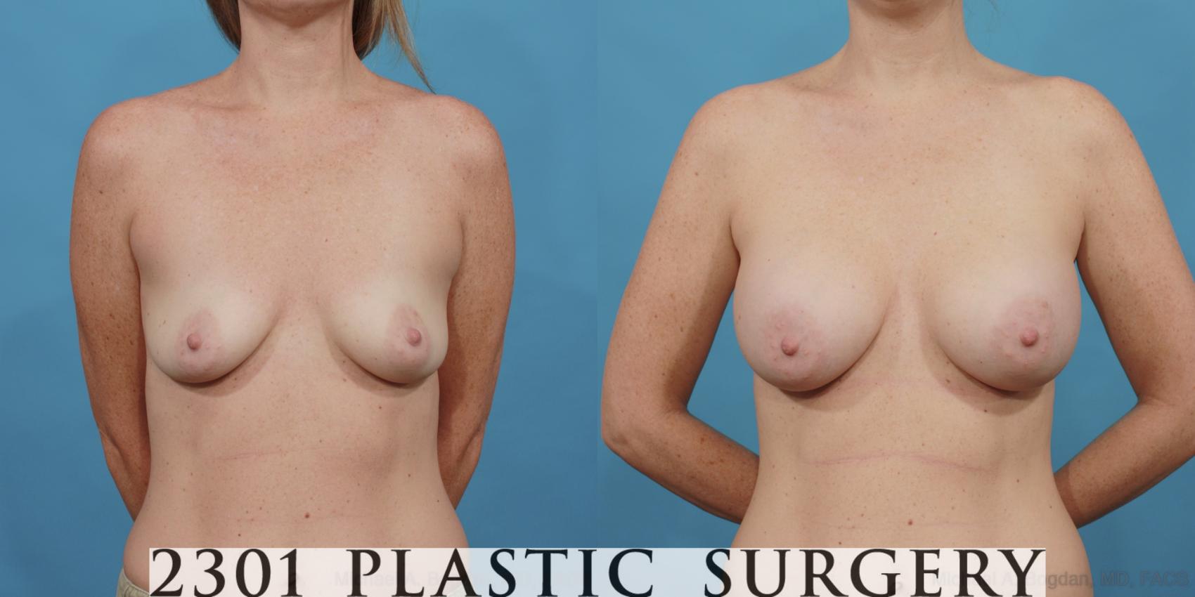 Before & After Silicone Implants Case 519 View #1 View in Fort Worth, Plano, & Frisco, Texas