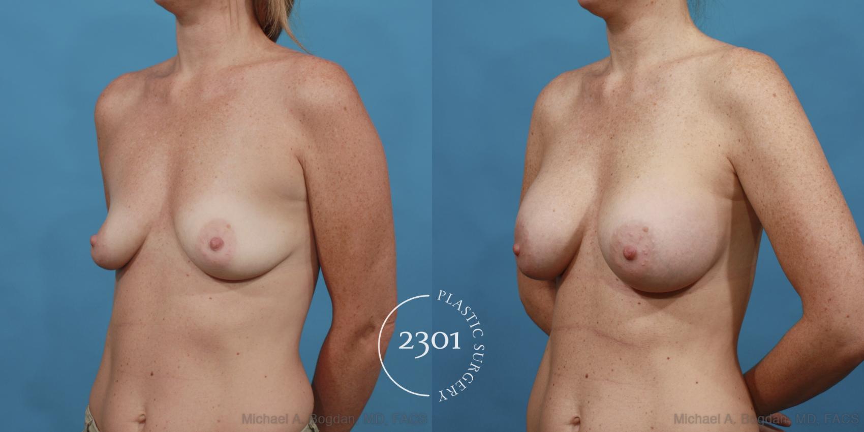Before & After Silicone Implants Case 519 View #2 View in Fort Worth, Plano, & Frisco, Texas