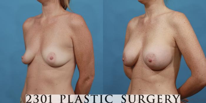 Before & After Silicone Implants Case 519 View #2 View in Fort Worth, Plano, & Frisco, Texas