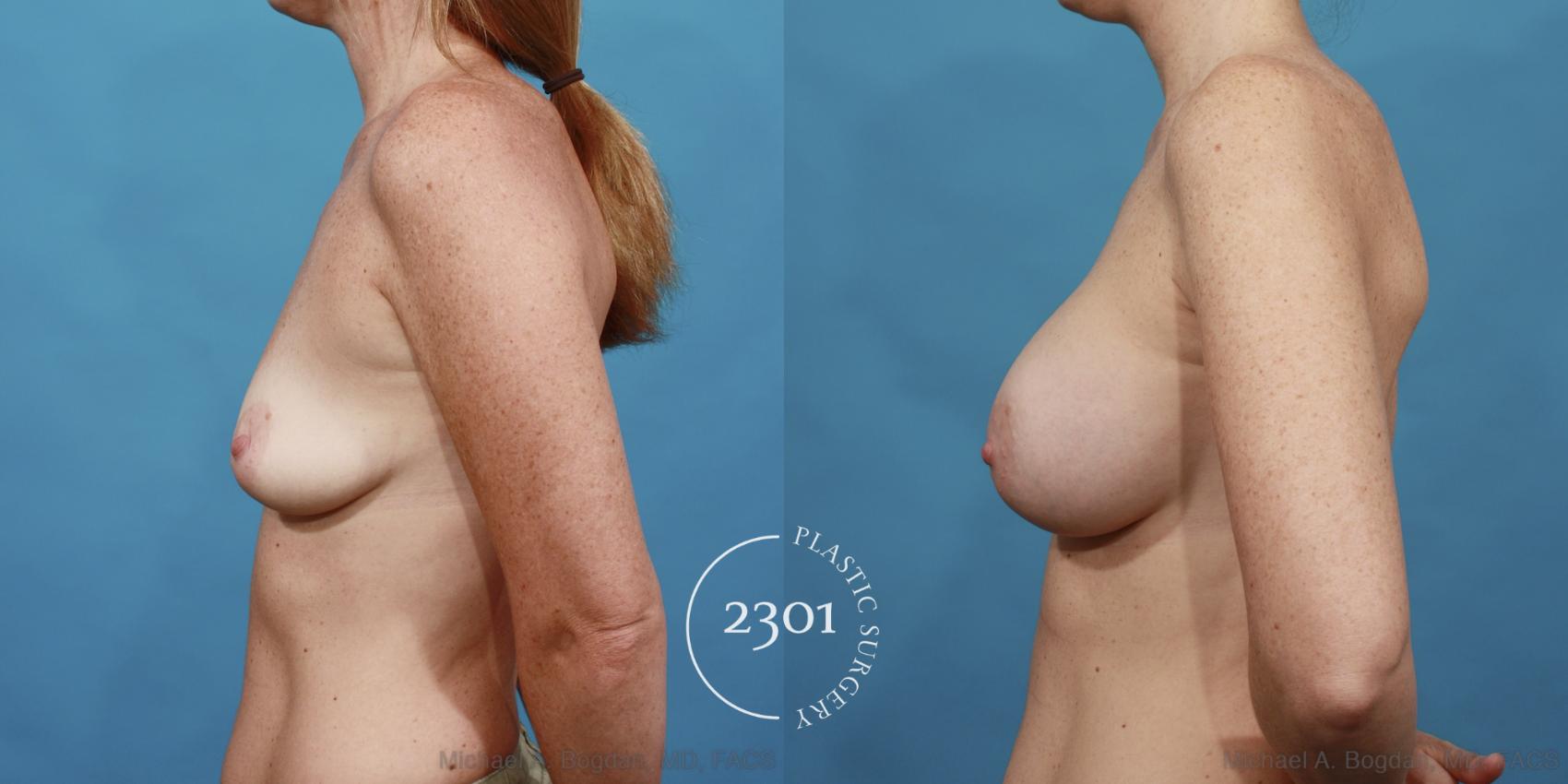 Before & After Silicone Implants Case 519 View #3 View in Fort Worth, Plano, & Frisco, Texas