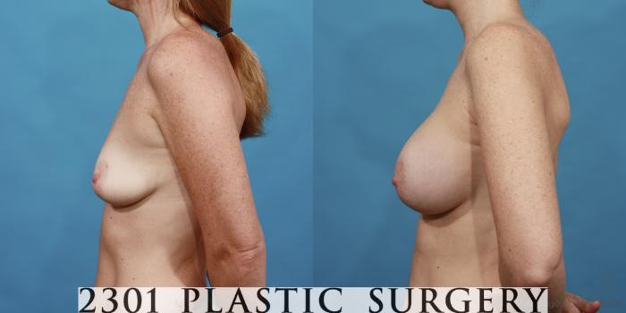 Before & After Silicone Implants Case 519 View #3 View in Fort Worth, Plano, & Frisco, Texas