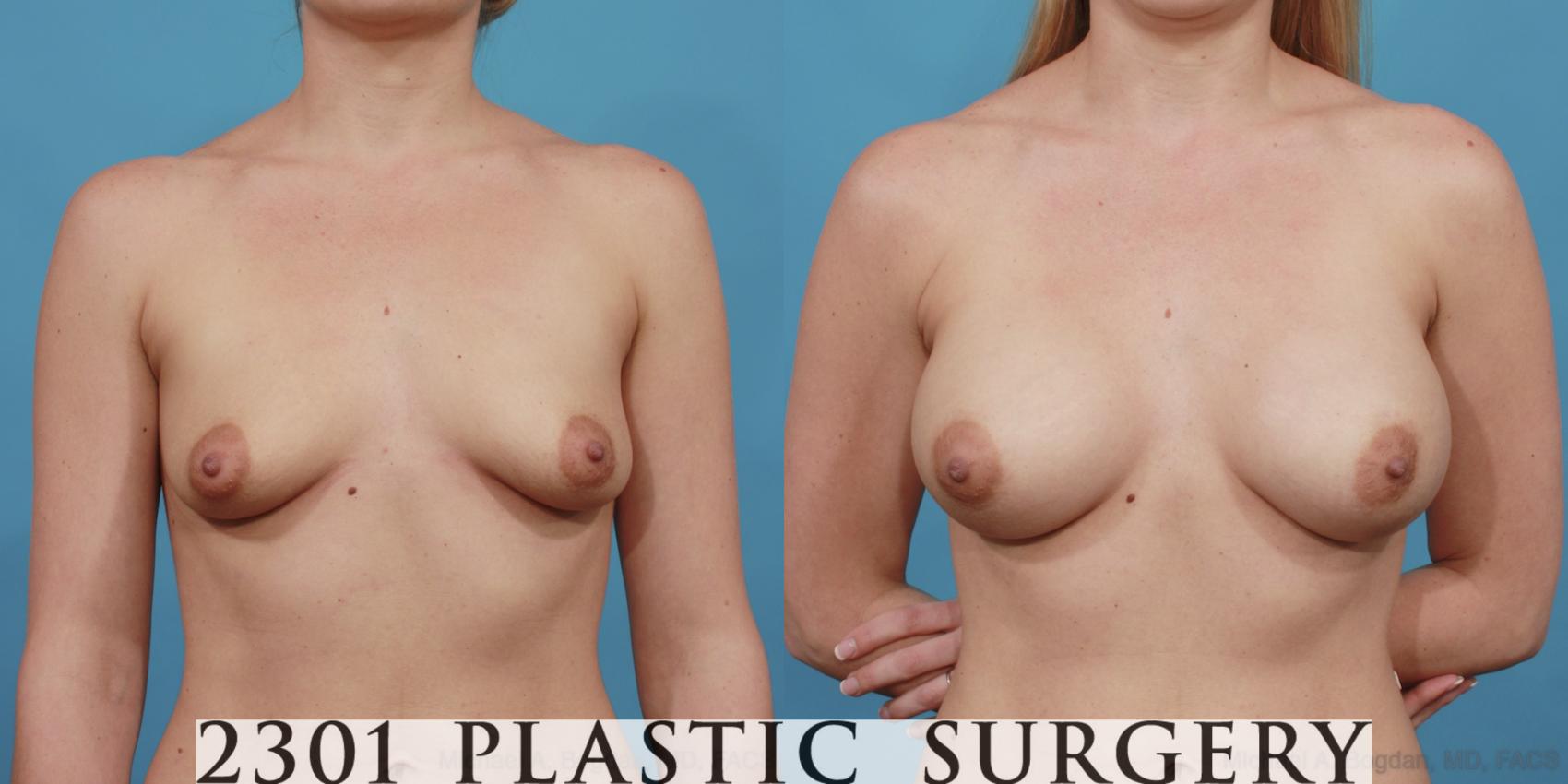 Before & After Silicone Implants Case 530 View #1 View in Fort Worth, Plano, & Frisco, Texas