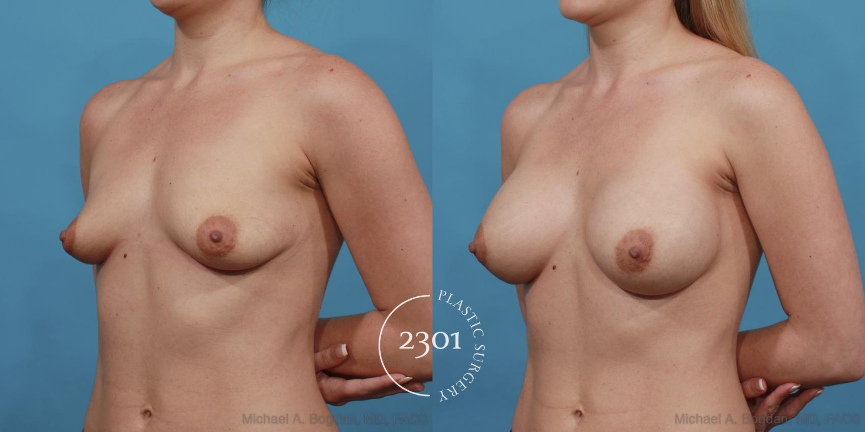 Before & After Silicone Implants Case 530 View #2 View in Fort Worth, Plano, & Frisco, Texas