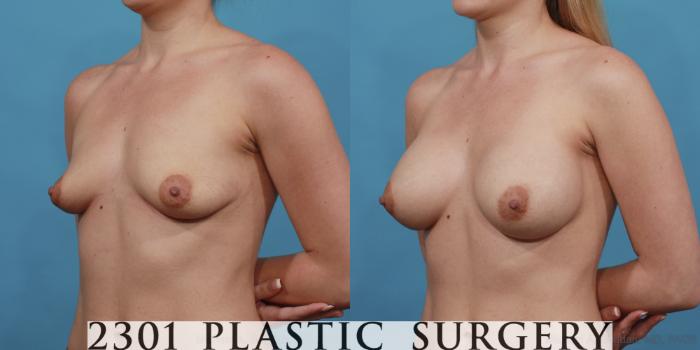 Before & After Silicone Implants Case 530 View #2 View in Fort Worth, Plano, & Frisco, Texas