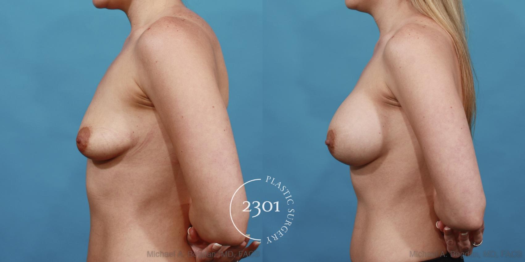 Before & After Silicone Implants Case 530 View #3 View in Fort Worth, Plano, & Frisco, Texas