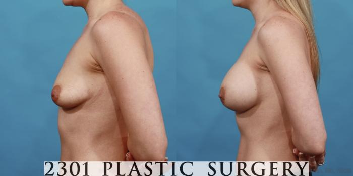 Before & After Silicone Implants Case 530 View #3 View in Fort Worth, Plano, & Frisco, Texas