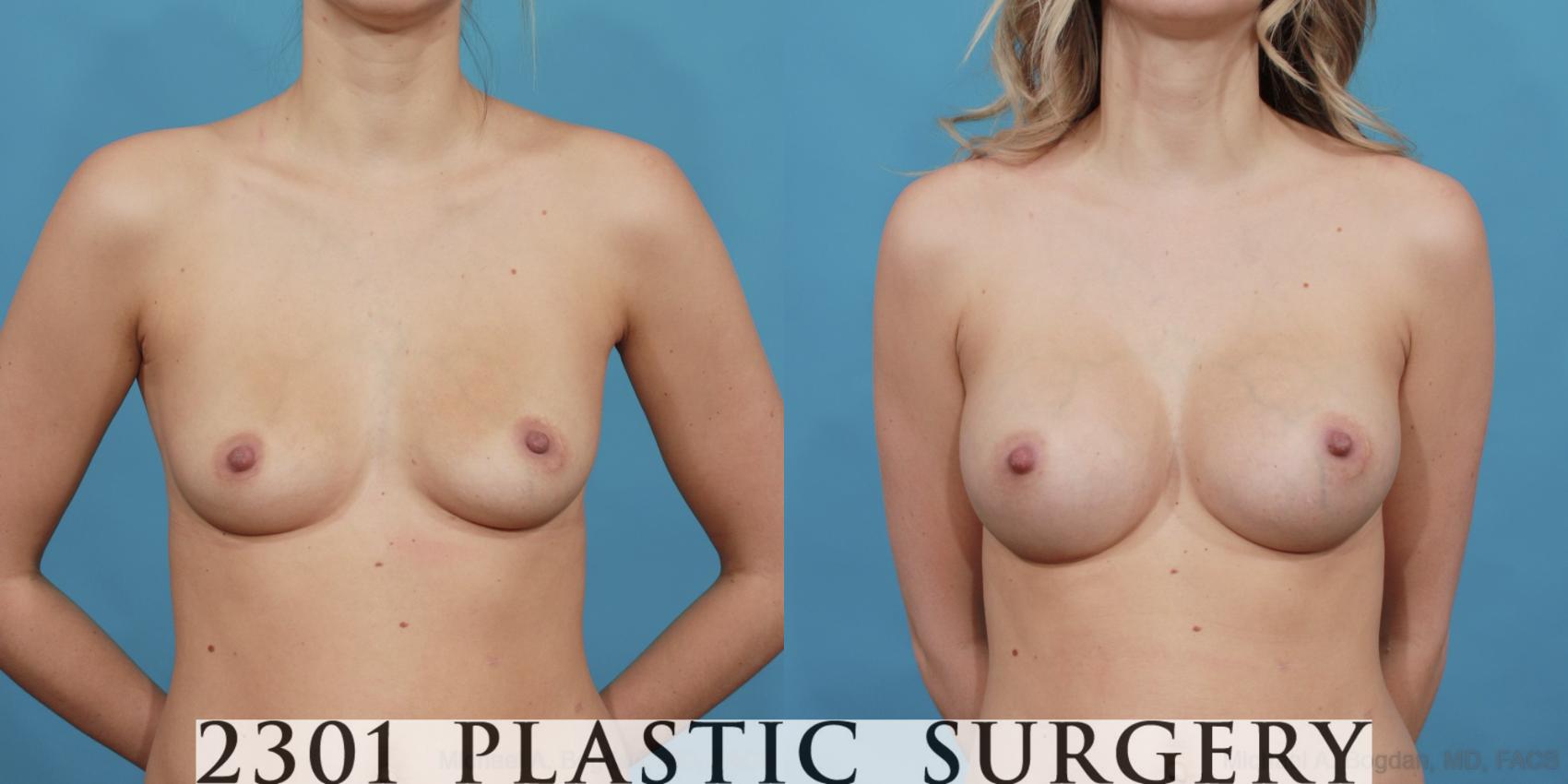 Before & After Silicone Implants Case 534 View #1 View in Fort Worth, Plano, & Frisco, Texas