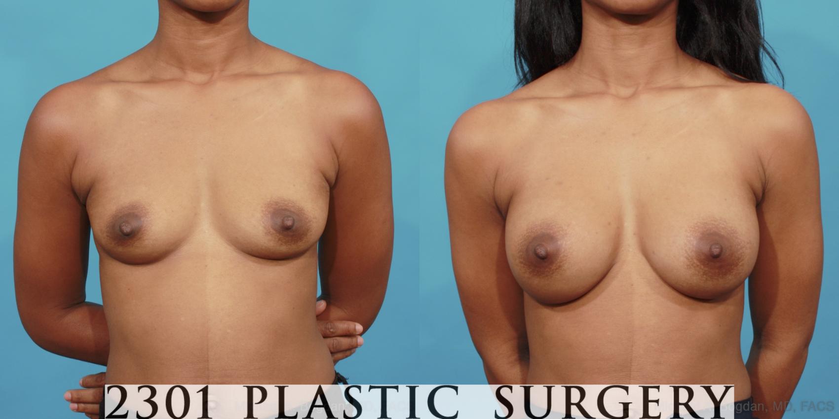 Before & After Silicone Implants Case 535 View #1 View in Fort Worth, Plano, & Frisco, Texas