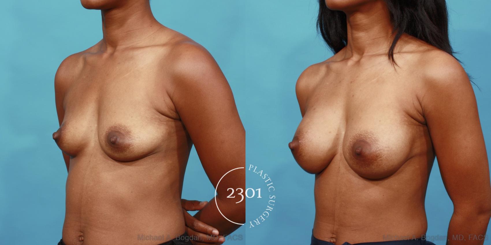 Before & After Silicone Implants Case 535 View #2 View in Fort Worth, Plano, & Frisco, Texas