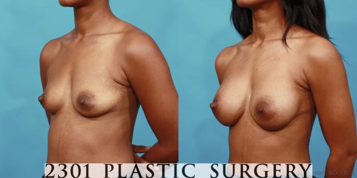 Before & After Silicone Implants Case 535 View #2 View in Fort Worth, Plano, & Frisco, Texas