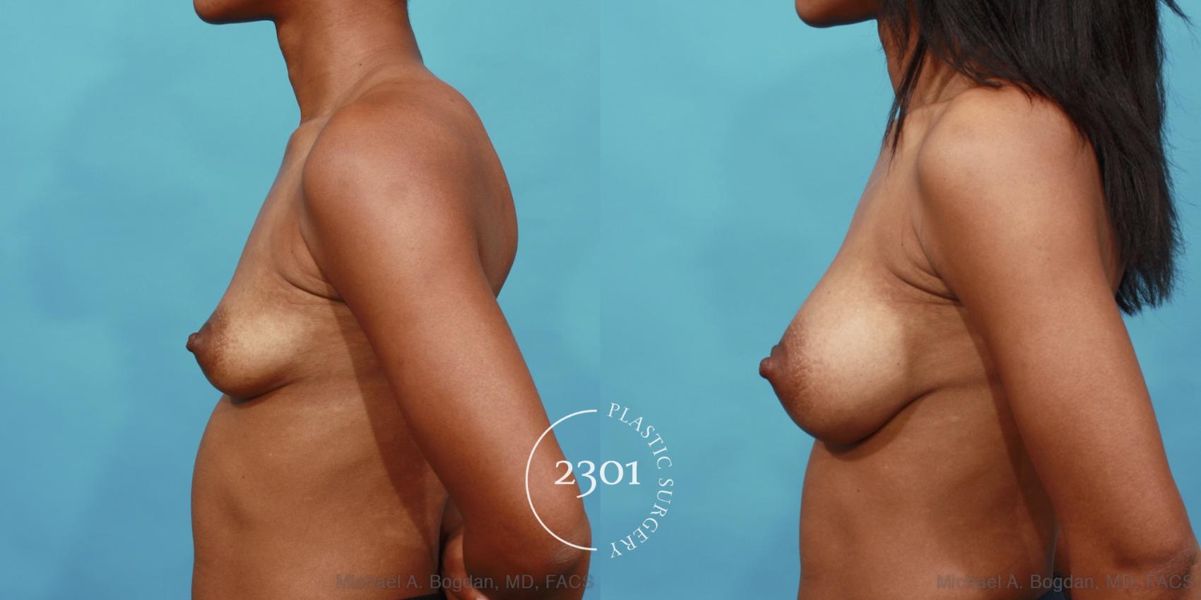 Before & After Silicone Implants Case 535 View #3 View in Fort Worth, Plano, & Frisco, Texas