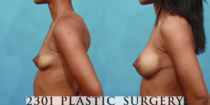 Before & After Silicone Implants Case 535 View #3 View in Fort Worth, Plano, & Frisco, Texas