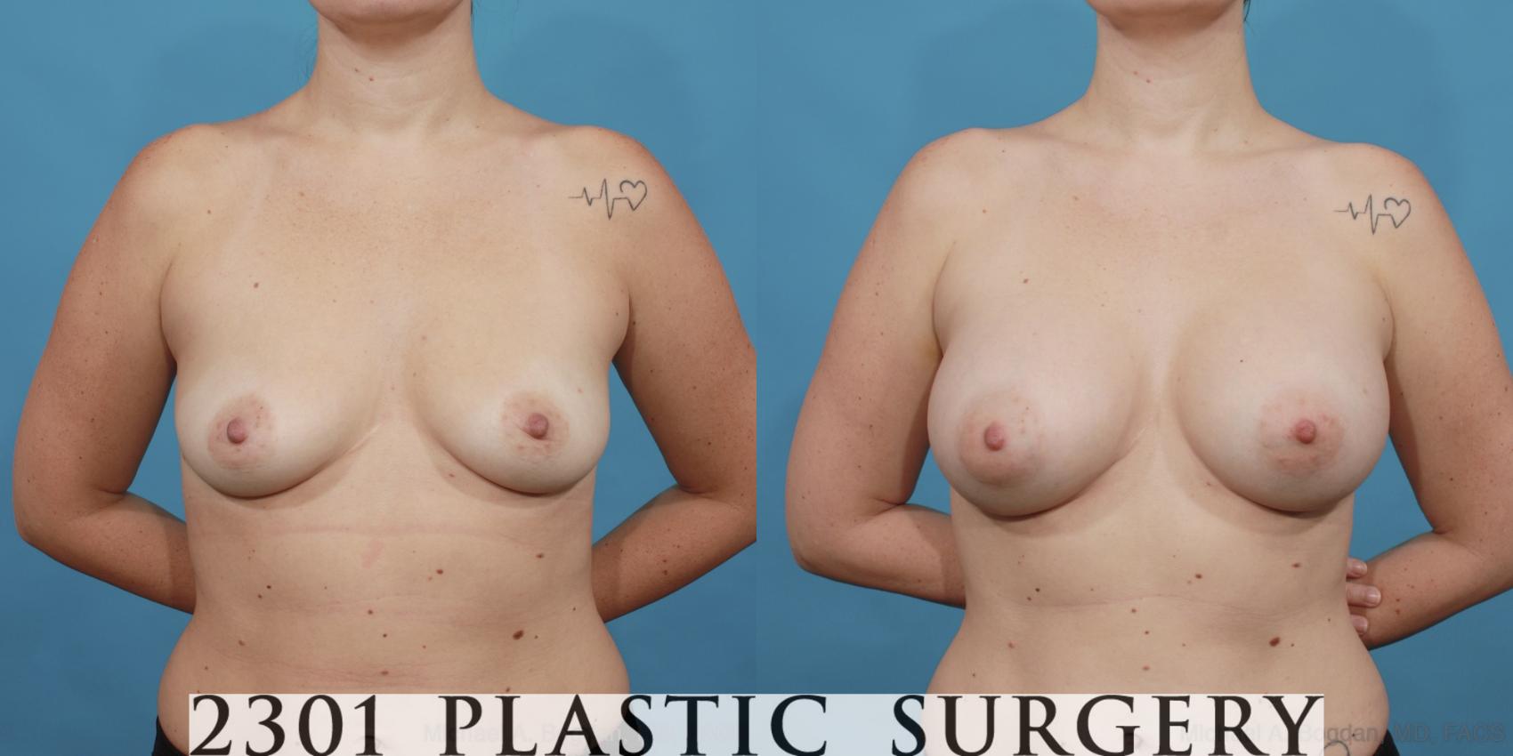 Before & After Silicone Implants Case 536 View #1 View in Fort Worth, Plano, & Frisco, Texas