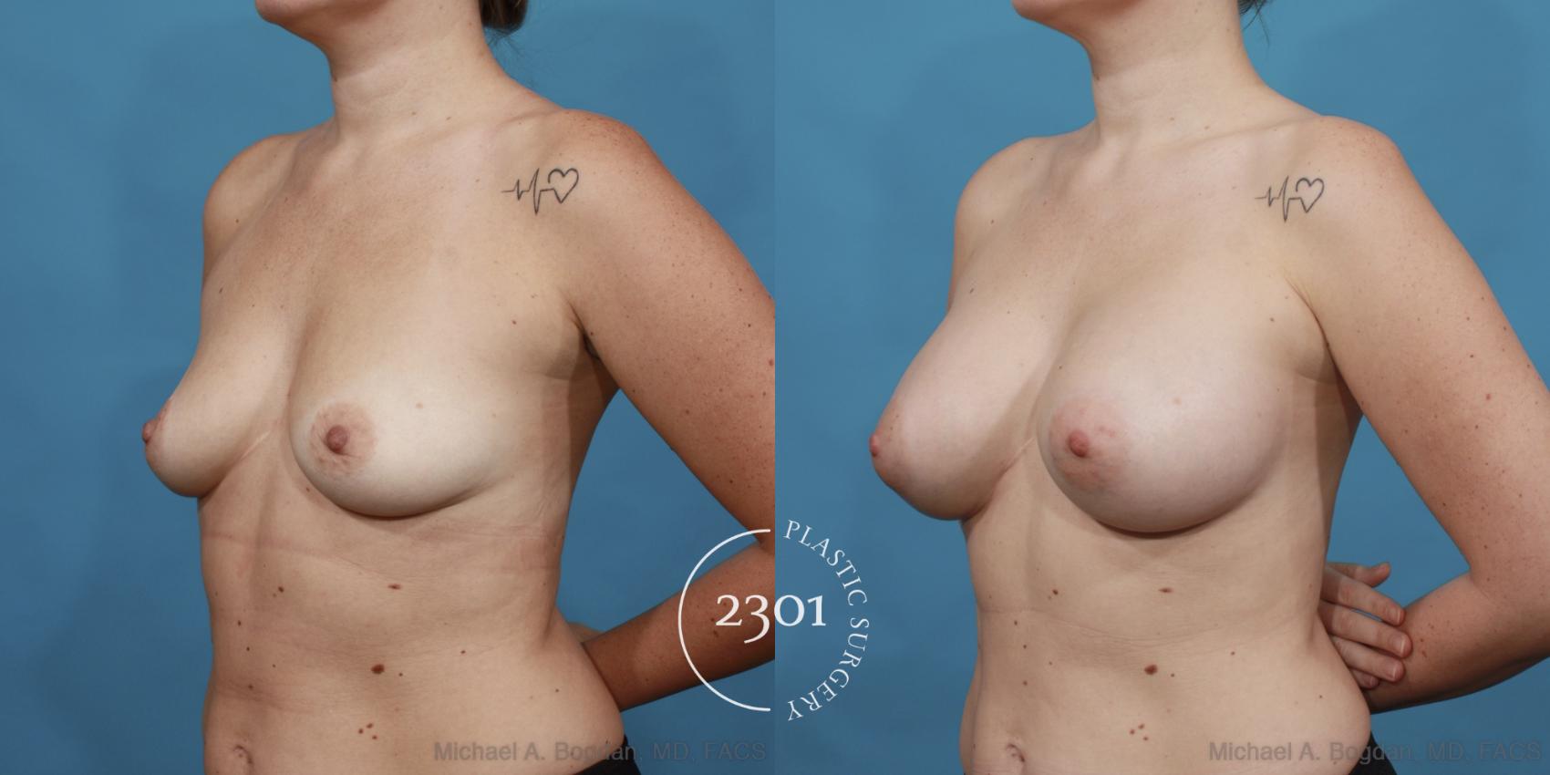 Before & After Silicone Implants Case 536 View #2 View in Fort Worth, Plano, & Frisco, Texas