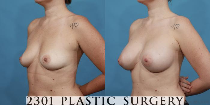 Before & After Silicone Implants Case 536 View #2 View in Fort Worth, Plano, & Frisco, Texas