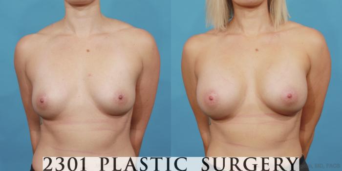 Before & After Silicone Implants Case 548 View #1 View in Fort Worth, Plano, & Frisco, Texas