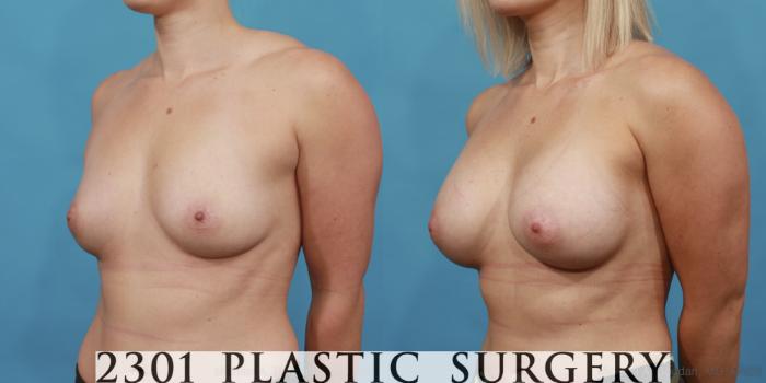 Before & After Silicone Implants Case 548 View #2 View in Fort Worth, Plano, & Frisco, Texas