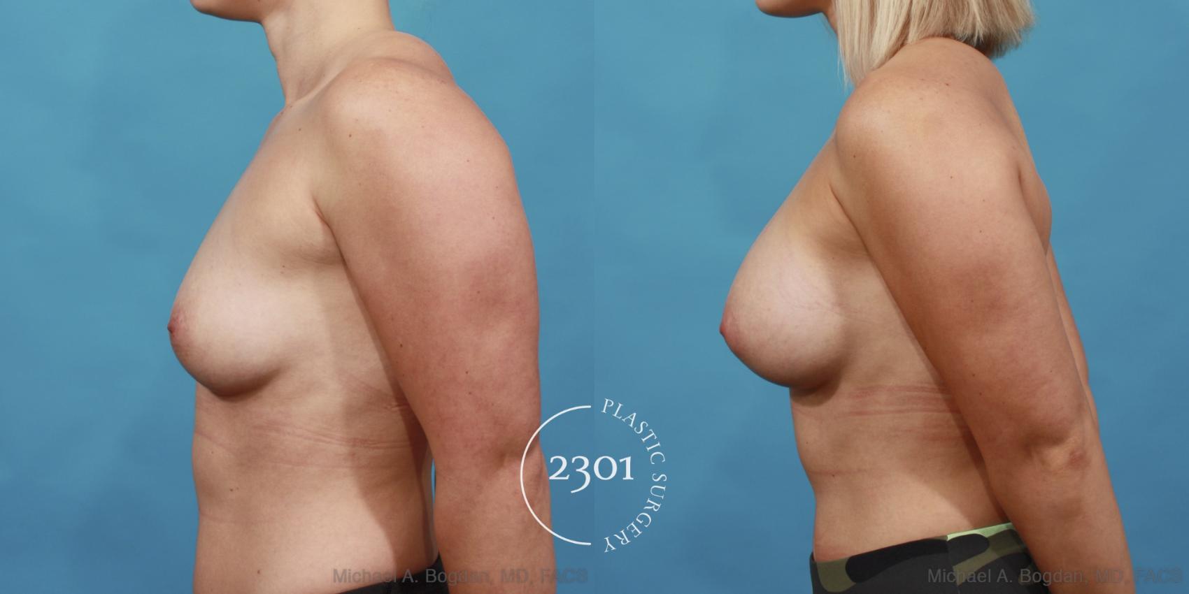 Before & After Silicone Implants Case 548 View #3 View in Fort Worth, Plano, & Frisco, Texas