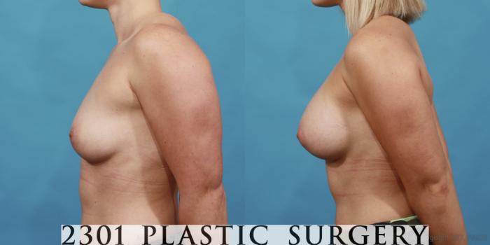 Before & After Silicone Implants Case 548 View #3 View in Fort Worth, Plano, & Frisco, Texas
