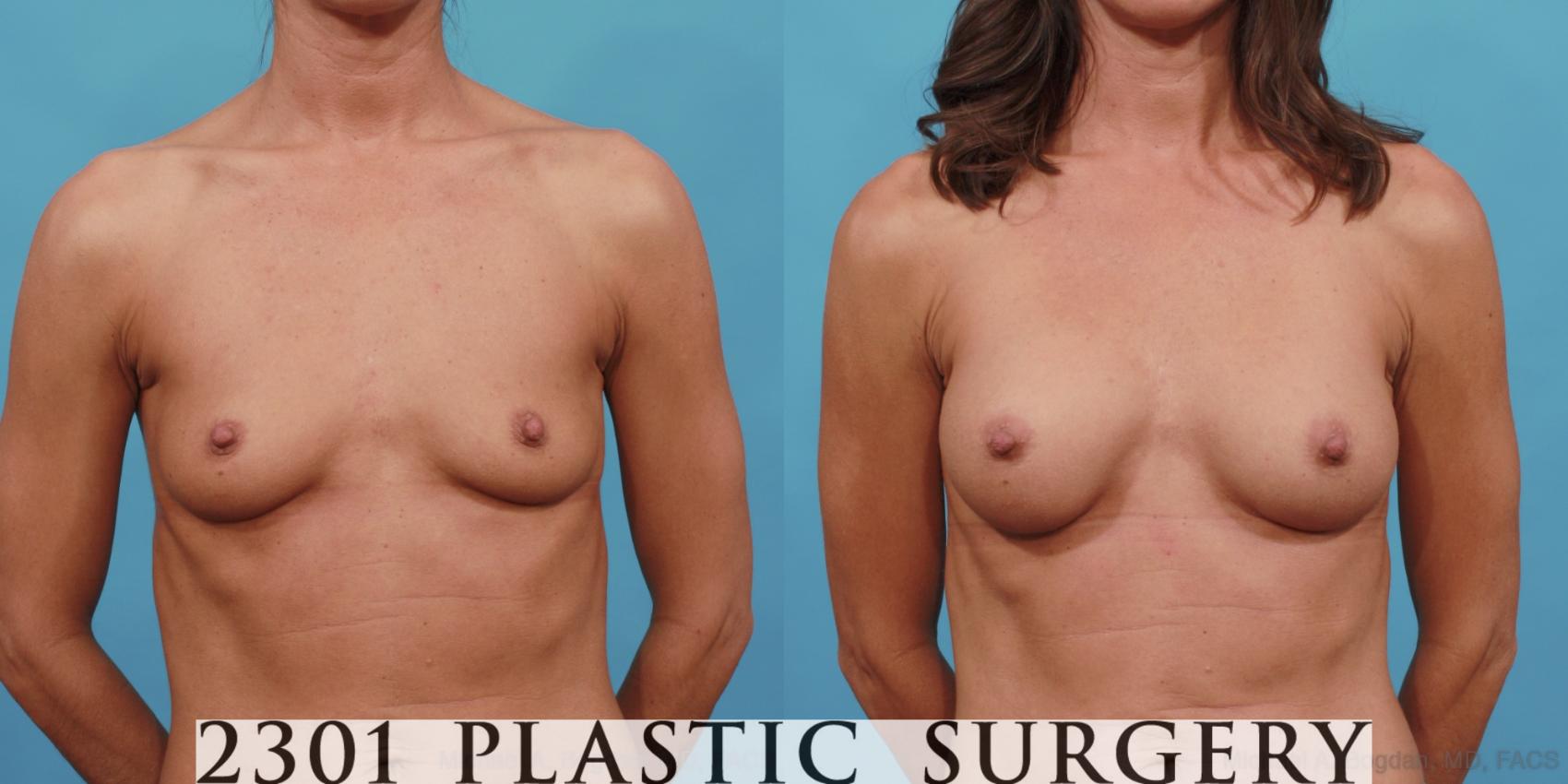 Before & After Silicone Implants Case 557 View #1 View in Fort Worth & Frisco, Texas