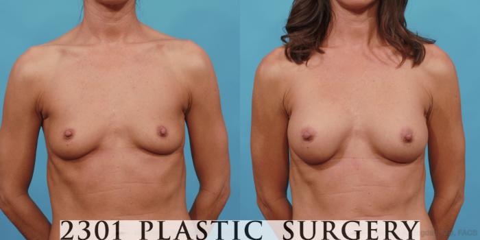 Before & After Silicone Implants Case 557 View #1 View in Fort Worth, Plano, & Frisco, Texas