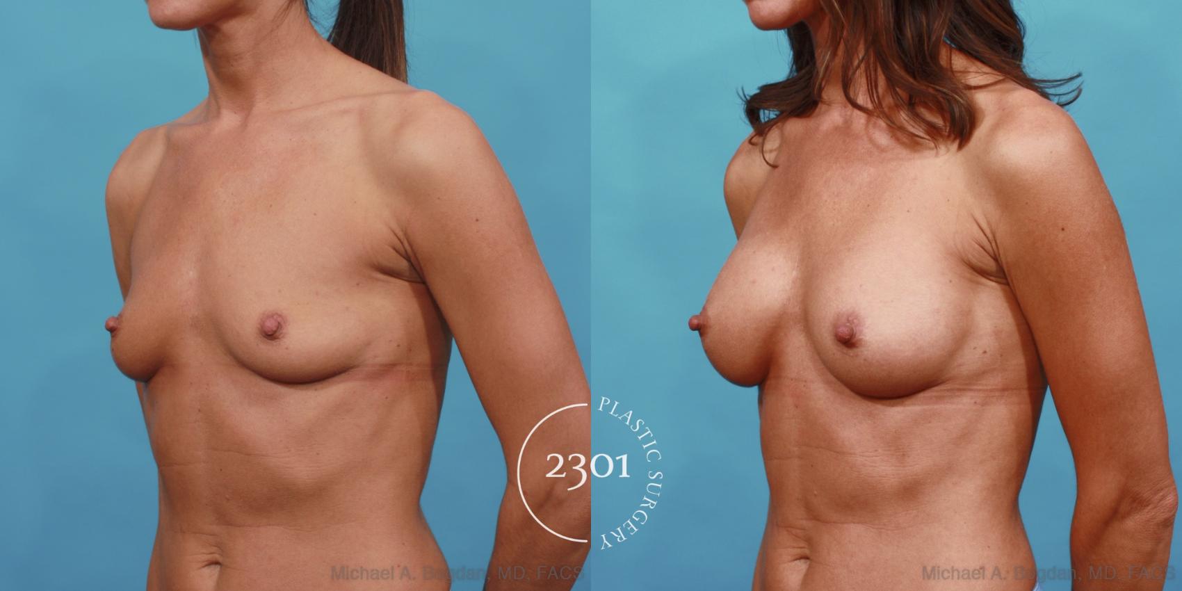 Before & After Breast Augmentation Case 557 View #2 View in Fort Worth, Plano, & Frisco, Texas