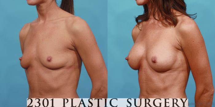 Before & After Silicone Implants Case 557 View #2 View in Fort Worth, Plano, & Frisco, Texas