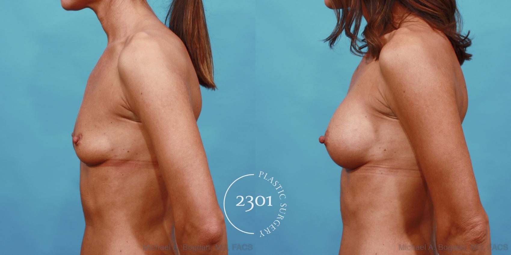 Before & After Breast Augmentation Case 557 View #3 View in Fort Worth, Plano, & Frisco, Texas